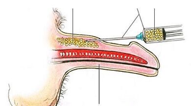 Surgical method to increase the member