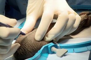 Mosquito incision for surgical penis enlargement