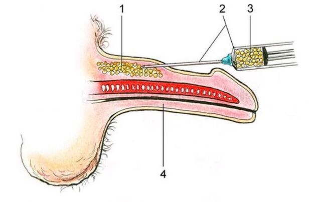 Penis enlargement with hyaluronic acid injections