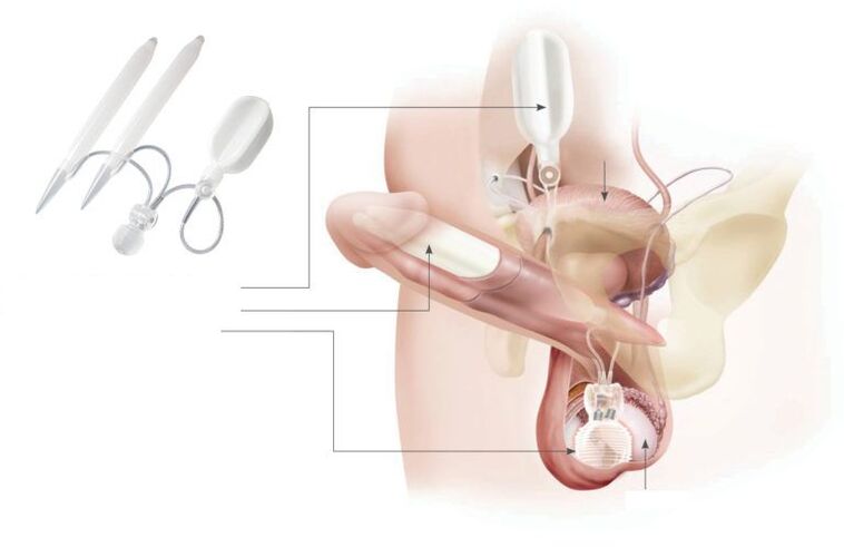 Gel implants in the penis