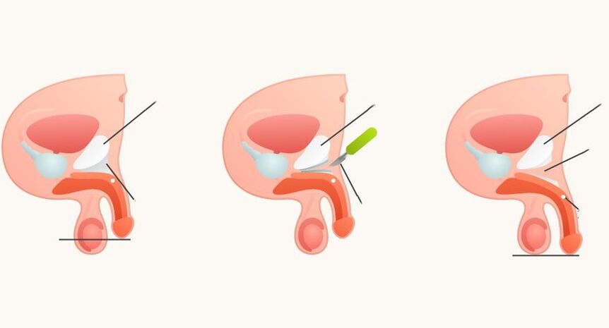 Ligamentotomy for penis enlargement